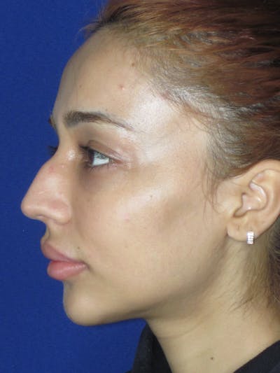 Rhinoplasty Before & After Gallery - Patient 533445 - Image 1