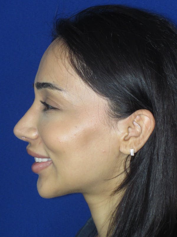 Rhinoplasty Before & After Gallery - Patient 533445 - Image 4