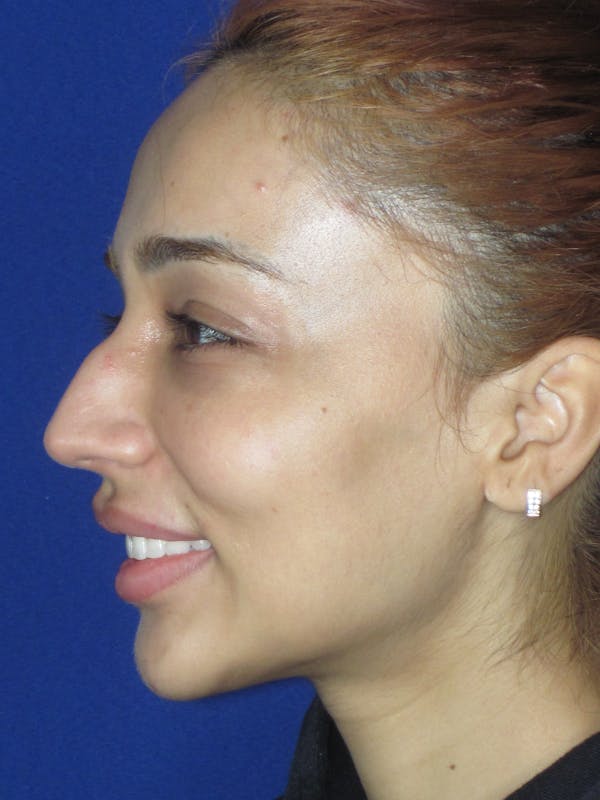 Rhinoplasty Before & After Gallery - Patient 533445 - Image 3