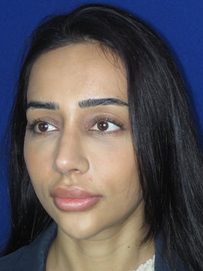 Rhinoplasty Before & After Gallery - Patient 533445 - Image 6