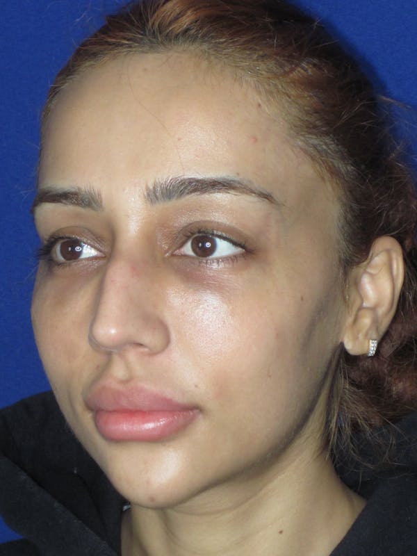 Rhinoplasty Before & After Gallery - Patient 533445 - Image 5
