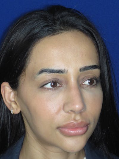Rhinoplasty Before & After Gallery - Patient 533445 - Image 8