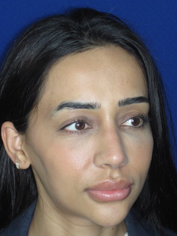 Rhinoplasty Before & After Gallery - Patient 533445 - Image 8