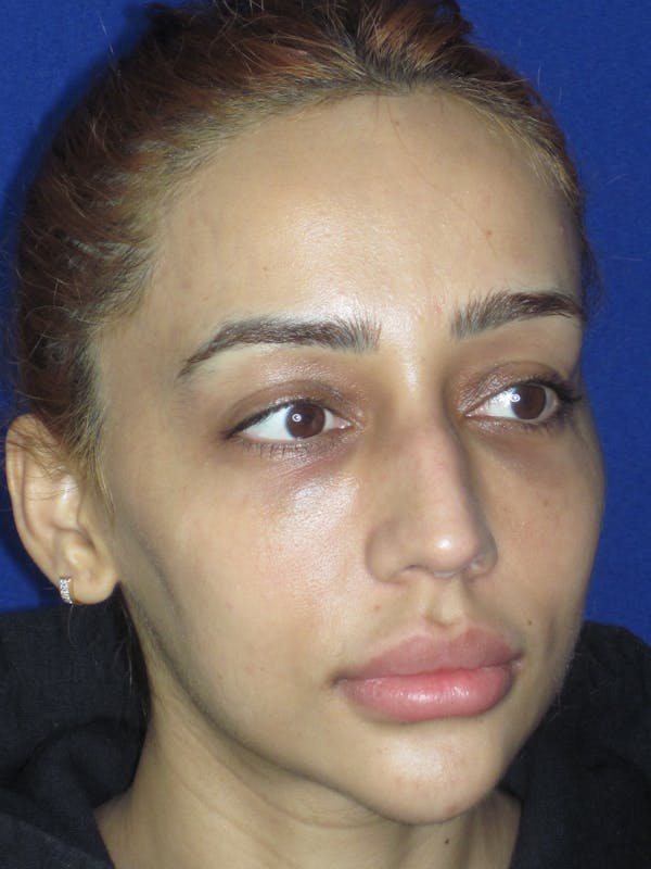 Rhinoplasty Before & After Gallery - Patient 533445 - Image 7