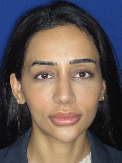 Rhinoplasty Before & After Gallery - Patient 533445 - Image 10