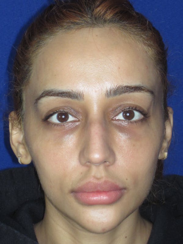 Rhinoplasty Before & After Gallery - Patient 533445 - Image 9