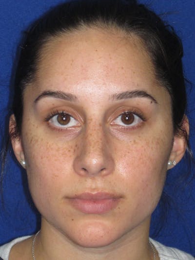 Rhinoplasty Before & After Gallery - Patient 259390 - Image 2