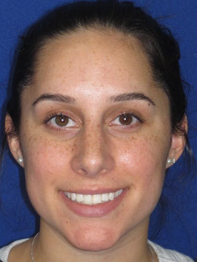 Rhinoplasty Before & After Gallery - Patient 259390 - Image 4