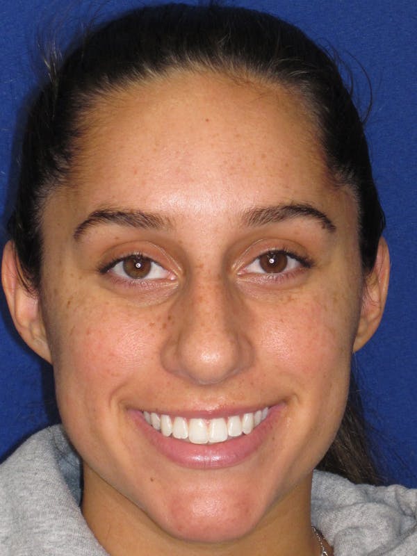 Rhinoplasty Before & After Gallery - Patient 259390 - Image 3