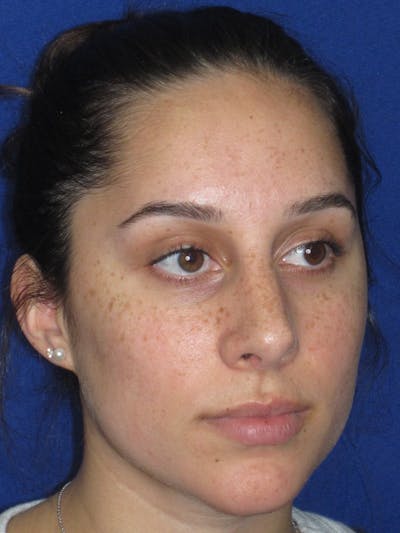 Rhinoplasty Before & After Gallery - Patient 259390 - Image 6