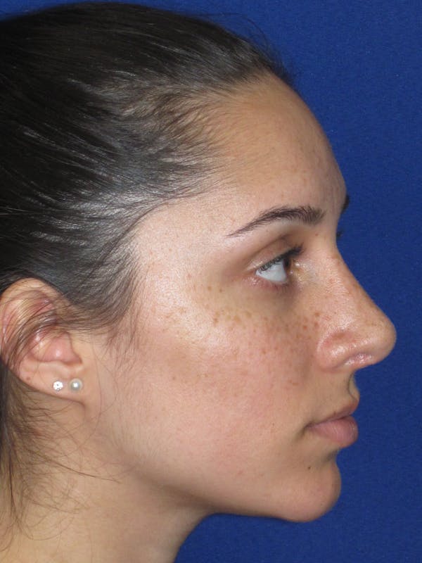 Rhinoplasty Before & After Gallery - Patient 259390 - Image 8