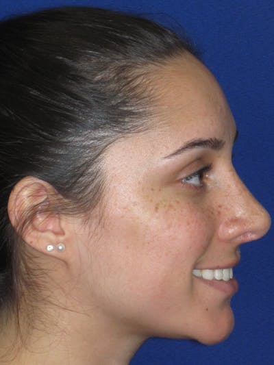 Rhinoplasty Before & After Gallery - Patient 259390 - Image 10