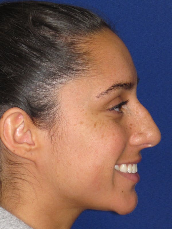 Rhinoplasty Before & After Gallery - Patient 259390 - Image 9
