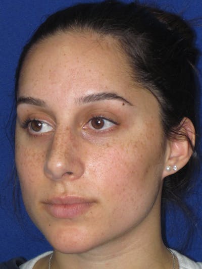 Rhinoplasty Before & After Gallery - Patient 259390 - Image 12