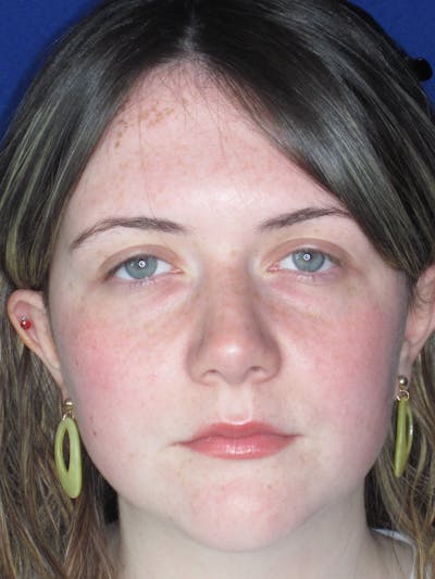 Rhinoplasty Before & After Gallery - Patient 220355 - Image 2