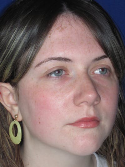 Rhinoplasty Before & After Gallery - Patient 220355 - Image 4