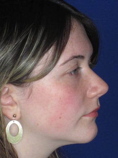 Rhinoplasty Before & After Gallery - Patient 220355 - Image 6