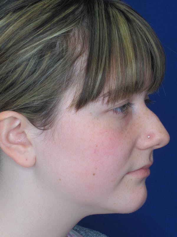 Rhinoplasty Before & After Gallery - Patient 220355 - Image 5