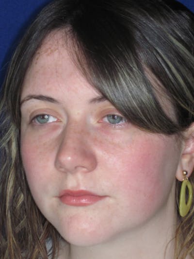 Rhinoplasty Before & After Gallery - Patient 220355 - Image 8