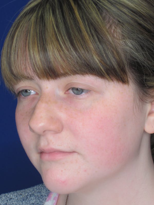 Rhinoplasty Before & After Gallery - Patient 220355 - Image 7