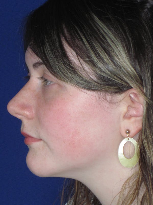 Rhinoplasty Before & After Gallery - Patient 220355 - Image 10