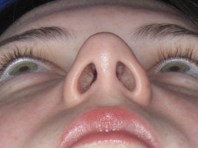 Rhinoplasty Before & After Gallery - Patient 220355 - Image 12
