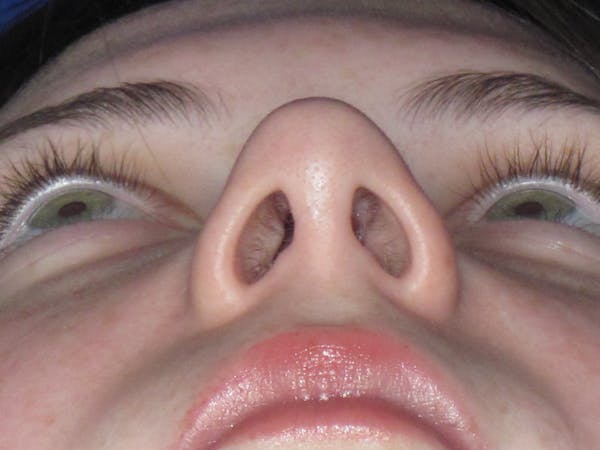 Rhinoplasty Before & After Gallery - Patient 220355 - Image 12