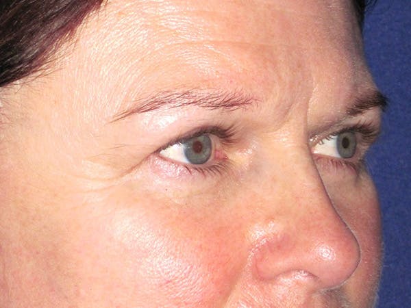 Browlift Before & After Gallery - Patient 143496 - Image 3