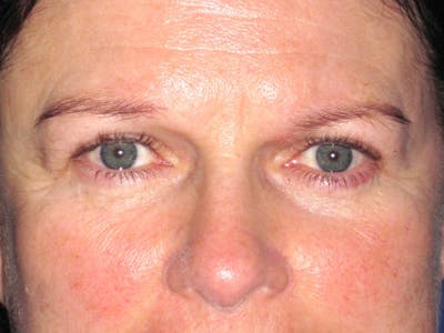 Browlift Before & After Gallery - Patient 143496 - Image 1