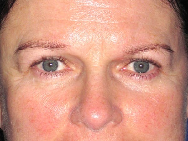 Browlift Before & After Gallery - Patient 143496 - Image 1
