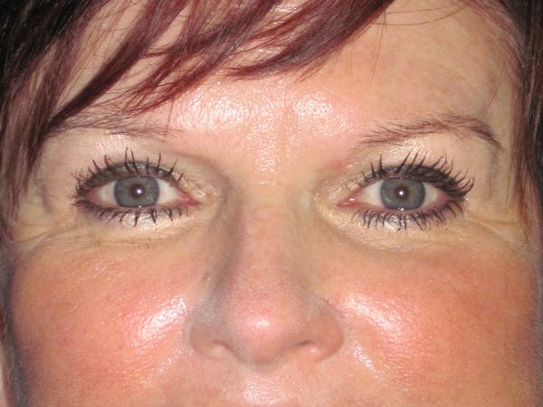 Browlift Before & After Gallery - Patient 143496 - Image 2