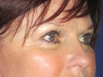 Browlift Before & After Gallery - Patient 143496 - Image 4