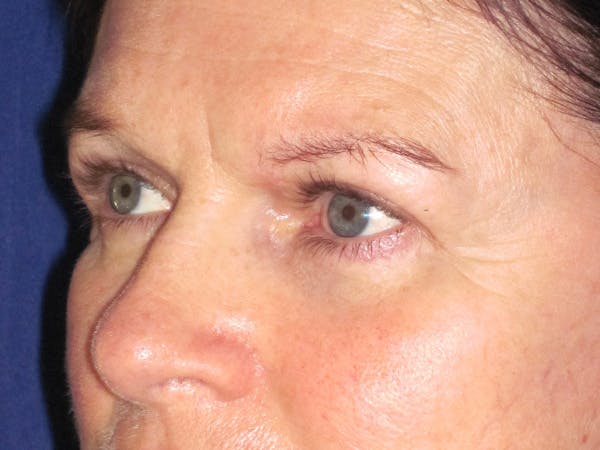 Browlift Before & After Gallery - Patient 143496 - Image 5