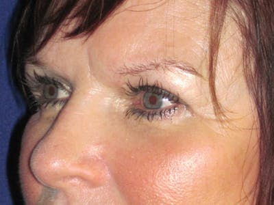 Browlift Before & After Gallery - Patient 143496 - Image 6