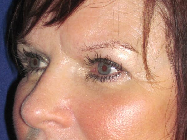 Browlift Before & After Gallery - Patient 143496 - Image 6