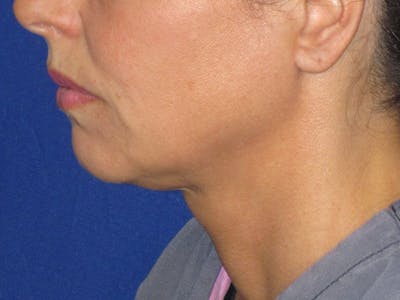 Neck Liposuction Before & After Gallery - Patient 256764 - Image 1
