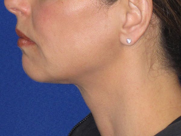 Neck Liposuction Before & After Gallery - Patient 256764 - Image 2