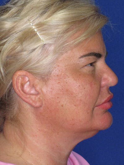 Neck Liposuction Before & After Gallery - Patient 339880 - Image 1