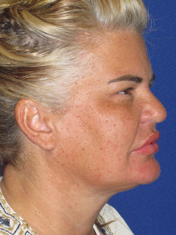 Neck Liposuction Before & After Gallery - Patient 339880 - Image 2