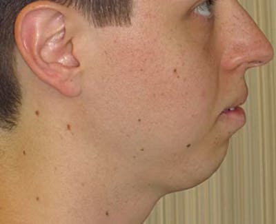 Chin Augmentation Before & After Gallery - Patient 4890583 - Image 1
