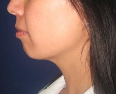 Chin Augmentation Before & After Gallery - Patient 4890588 - Image 1