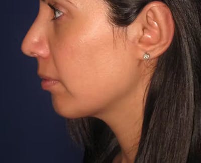 Chin Augmentation Before & After Gallery - Patient 4890588 - Image 2