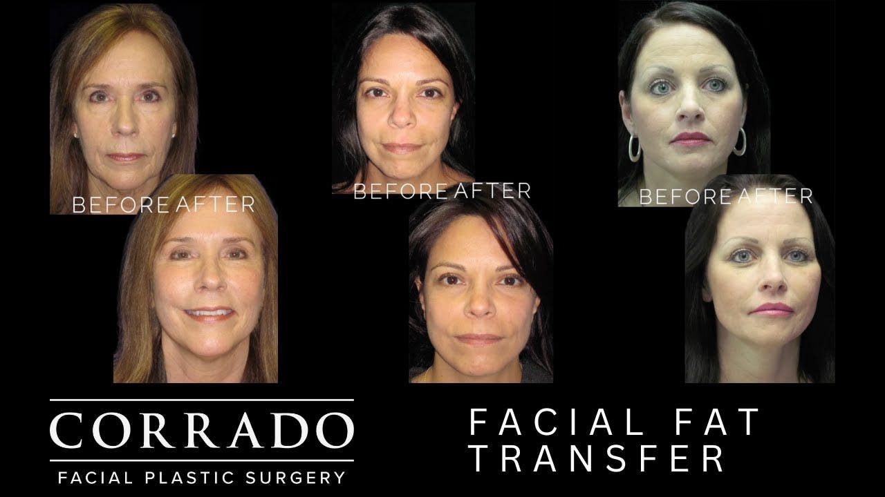 facial fat transfer video