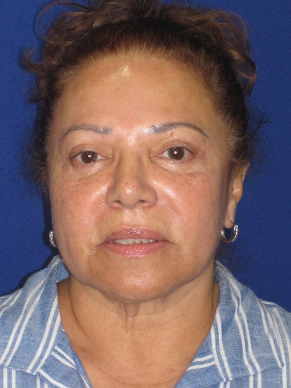 Facelift/Mini-Facelift Before & After Gallery - Patient 328211 - Image 3