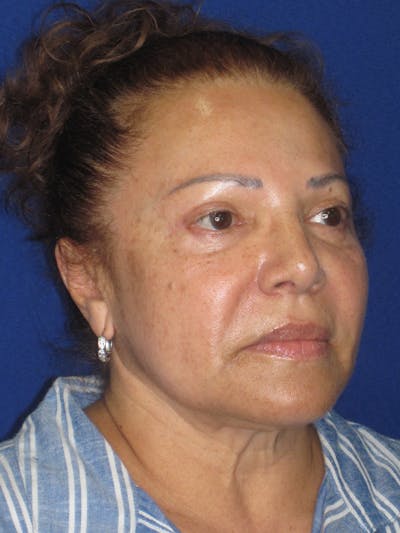 Facelift/Mini-Facelift Before & After Gallery - Patient 328211 - Image 1