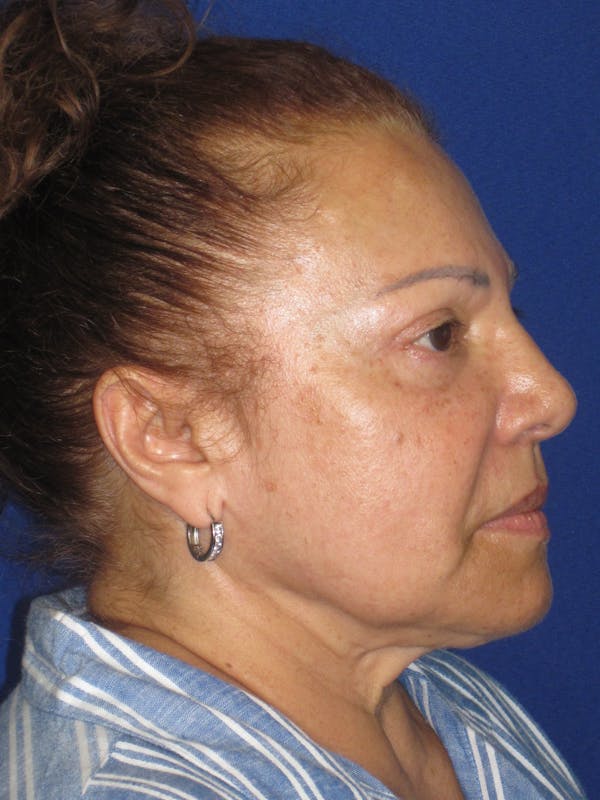 Facelift/Mini-Facelift Before & After Gallery - Patient 328211 - Image 5