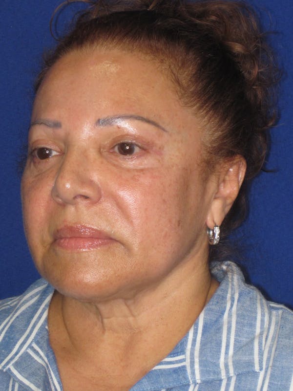 Facelift/Mini-Facelift Before & After Gallery - Patient 328211 - Image 7
