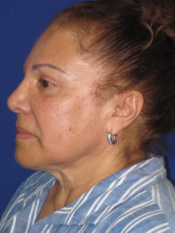 Facelift/Mini-Facelift Before & After Gallery - Patient 328211 - Image 9