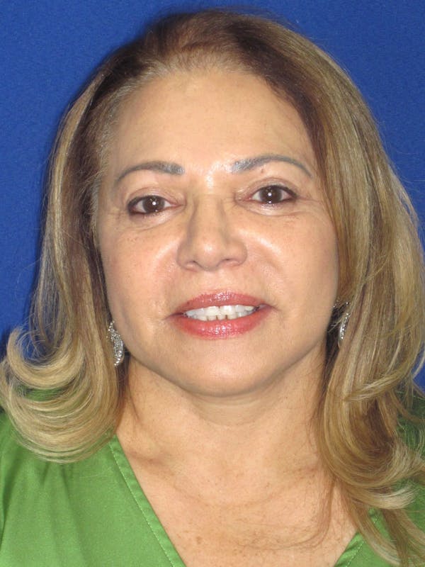Facelift/Mini-Facelift Before & After Gallery - Patient 328211 - Image 4