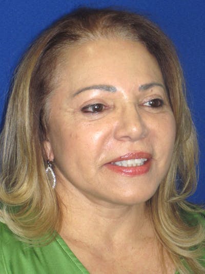 Facelift/Mini-Facelift Before & After Gallery - Patient 328211 - Image 2